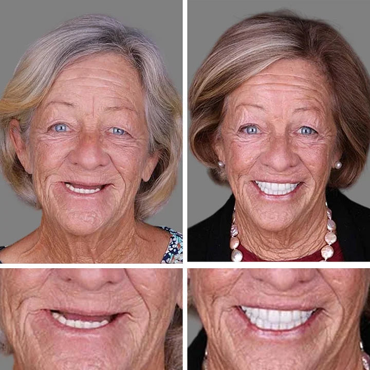 🏆Ends Today: 70% OFF! 🏆2026 Bestselling Product🦷 Fit for a Fresh Smile, Say Goodbye to Wearing Discomfort!🌎