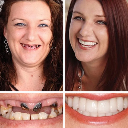 🏆Ends Today: 70% OFF! 🏆2026 Bestselling Product🦷 Fit for a Fresh Smile, Say Goodbye to Wearing Discomfort!🌎